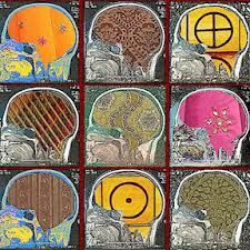 Rapid Response of Glioblastoma Multiforme with the Ketogenic Diet: A Case Report Rapid Response of Glioblastoma Multiforme with the Ketogenic Diet: A Case Report