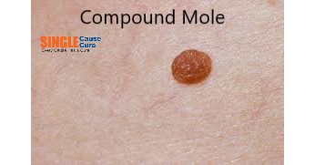 Mole removal cream