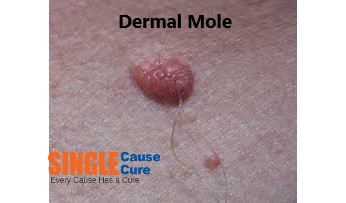 mole removal cream