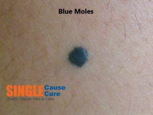 mole removal cream