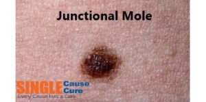 mole removal cream