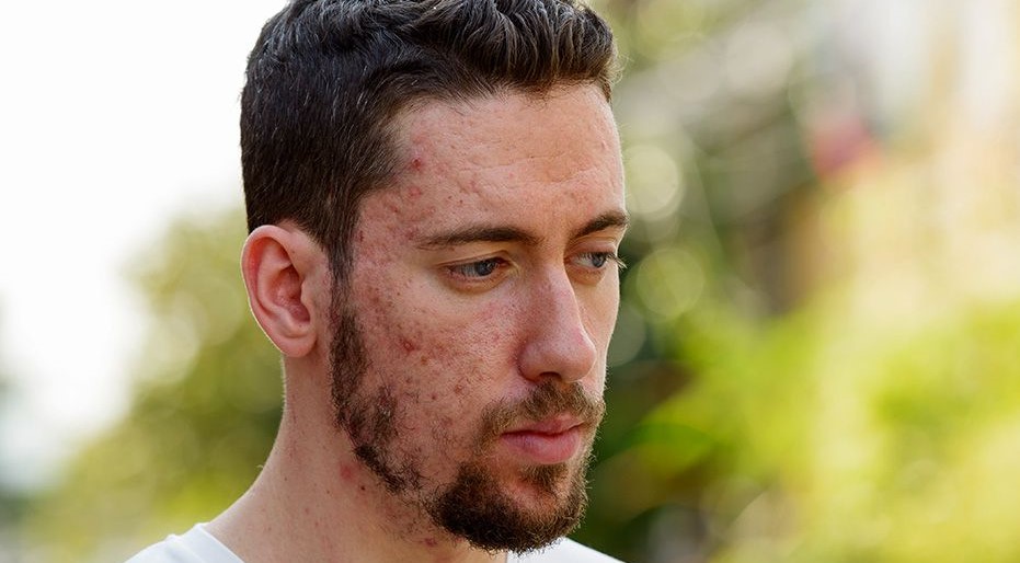 acne-scars lightening